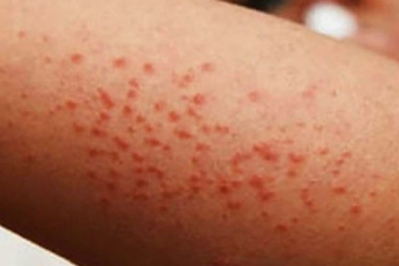 México registra 5 mil casos de sarampión y 23 muertes en 2025