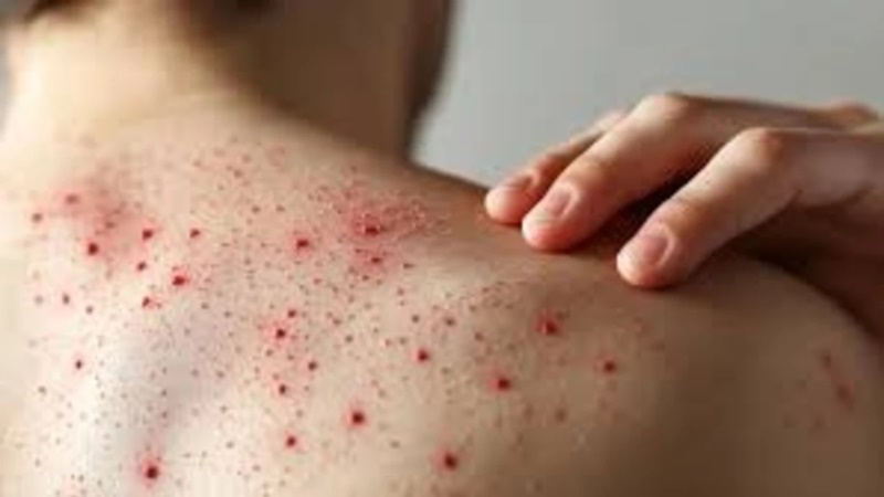 Sarampión se extiende a todo México; autoridades refuerzan llamado a vacunarse